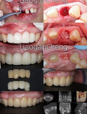 Teknologi Gradien Berlapis Berganda Zirconia Gigi Aman Dan Estetis untuk jangka panjang