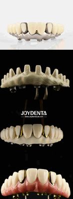Dental Estetika Titanium Malong Hybrid Jembatan Solusi Ultimate Untuk Restorasi Gigi