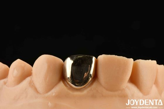 Pengalaman rehabilitasi mulut seperti tidak pernah sebelumnya dengan emas Crown Wax Casting