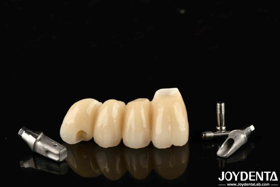 Korona Implan dan Jembatan yang Bisa Disesuaikan dengan Precision Porcelain Untuk Fungsi yang Sempurna