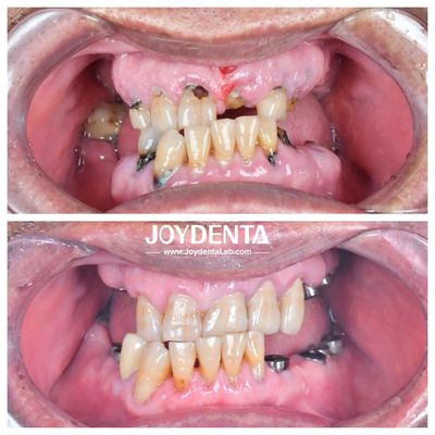Tahi pakai dan deformasi Zirconia mahkota gigi tahan lama dan cocok untuk restorasi belakang dan depan