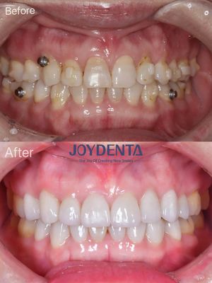 Restorasi Oral Veneer Porselen