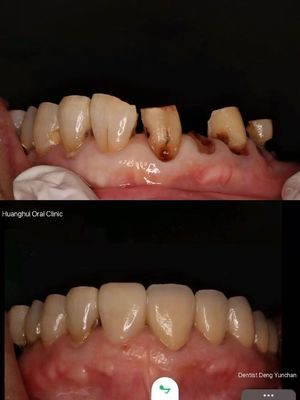 Mahkota Zirconia Premium untuk Laboratorium Gigi Global.