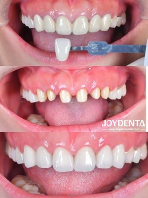 Studi Kasus Zirconia Dental Crown Global Lab Outsourcing - Joydentalab