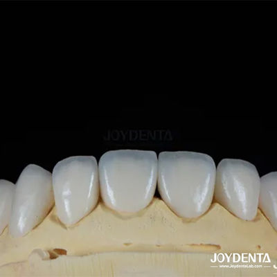 Tekstur Permukaan Glossy Feldspathic Veneer Natural Looking Porcelain Veneer