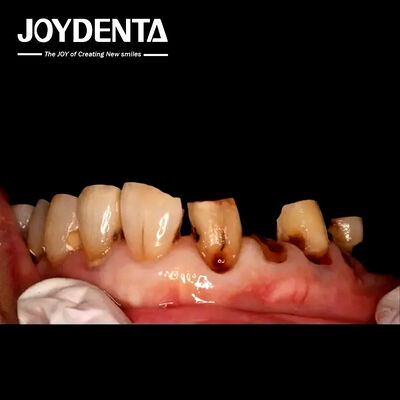 Mahkota Zirconia Premium untuk Laboratorium Gigi Global.
