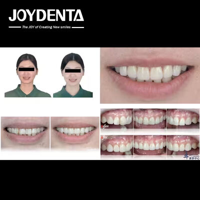 Produk populer Joydentalab: veneer estetika simulasi