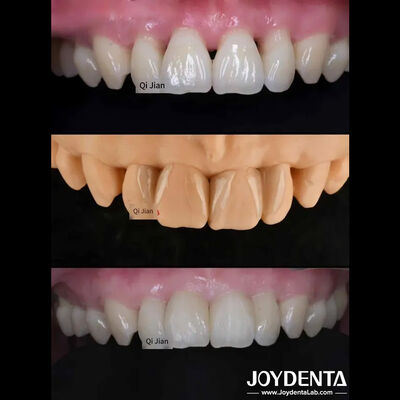 Grasshopper Veneers Solusi yang Sempurna untuk Garis Gigi Translucence Alam