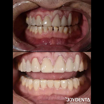 Bentuk Alam Kosmetik Kedokteran Gigi Porselin Veneers, Dental Kosmetik Porselin Veneers