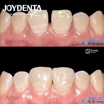 Aman Pas Porselen veneers Perawatan gigi Komposit resin veneers tahan noda