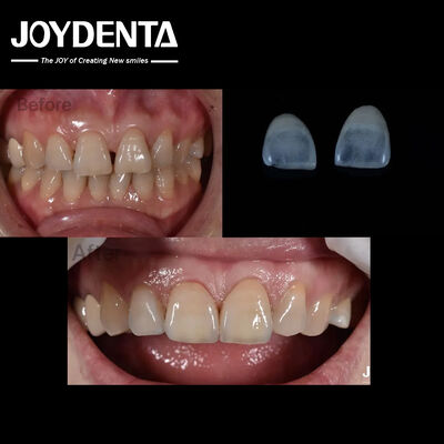 0.5mm Ketebalan keramik veneers gigi alami mencari gigi depan indikasi