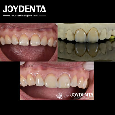 Veneer Gigi Ketebalan 0.5mm dengan Permeabilitas Sempurna Veneer Porselen