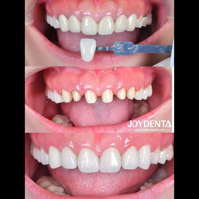 Studi Kasus Zirconia Dental Crown Global Lab Outsourcing - Joydentalab