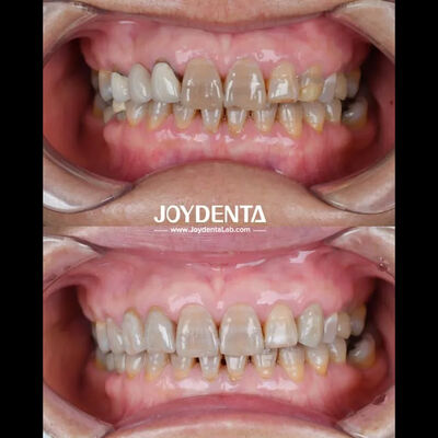 Zirconia Gigi Ringan Untuk Pengalaman Pasien yang Optimal Warna Alami