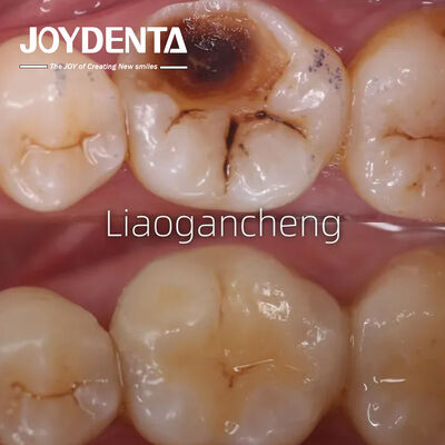 Inlay Gigi Porselin Restoratif Untuk Dewasa Dan Anak-anak Kinerja Luar Biasa