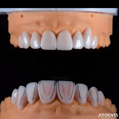 Custom Made Dental Emax Ceramic Veneers Dengan Resistensi noda Gloss Tinggi