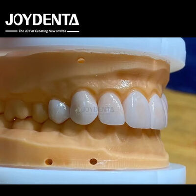Permeabilitas Tinggi Veneers terlihat alami Veneers Porselen Emax Disesuaikan