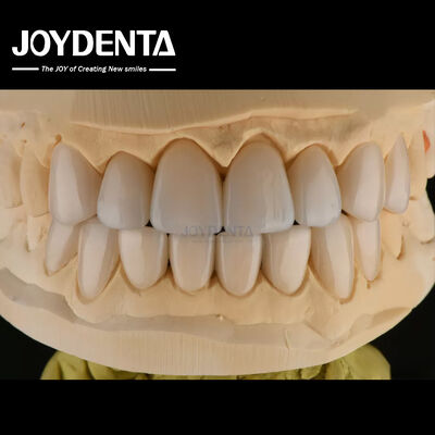 0.3-0.5mm tebal Feldspathic Porselen veneer tahan fraktur tinggi meningkatkan senyum Anda
