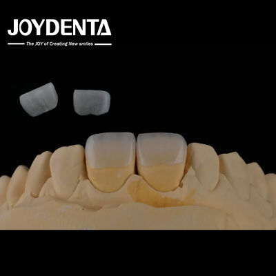 Lengan Dental Feldspathic Veneer Alam Warna Gigi Penampilan Translucent