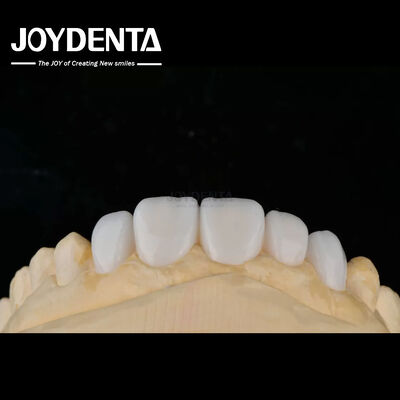 Personaliasi Bahan Porselen Emax veneer gigi untuk ikatan estetika tinggi